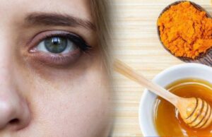 கண்ணுக்கு கீழ கருவளையமா..?? கவலையே வேண்டாம் இத பண்ணுங்க ..!!